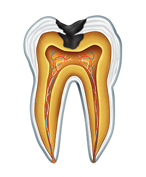 Cavity diagram.